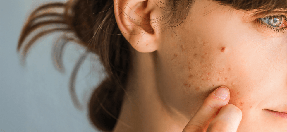 /on/demandware.static/-/Library-Sites-MultipharmaSharedLibrary/default/dwf0ae62b4/Home/Category Landing Pages/Acne behandeling/acne-article-1-981x451.png